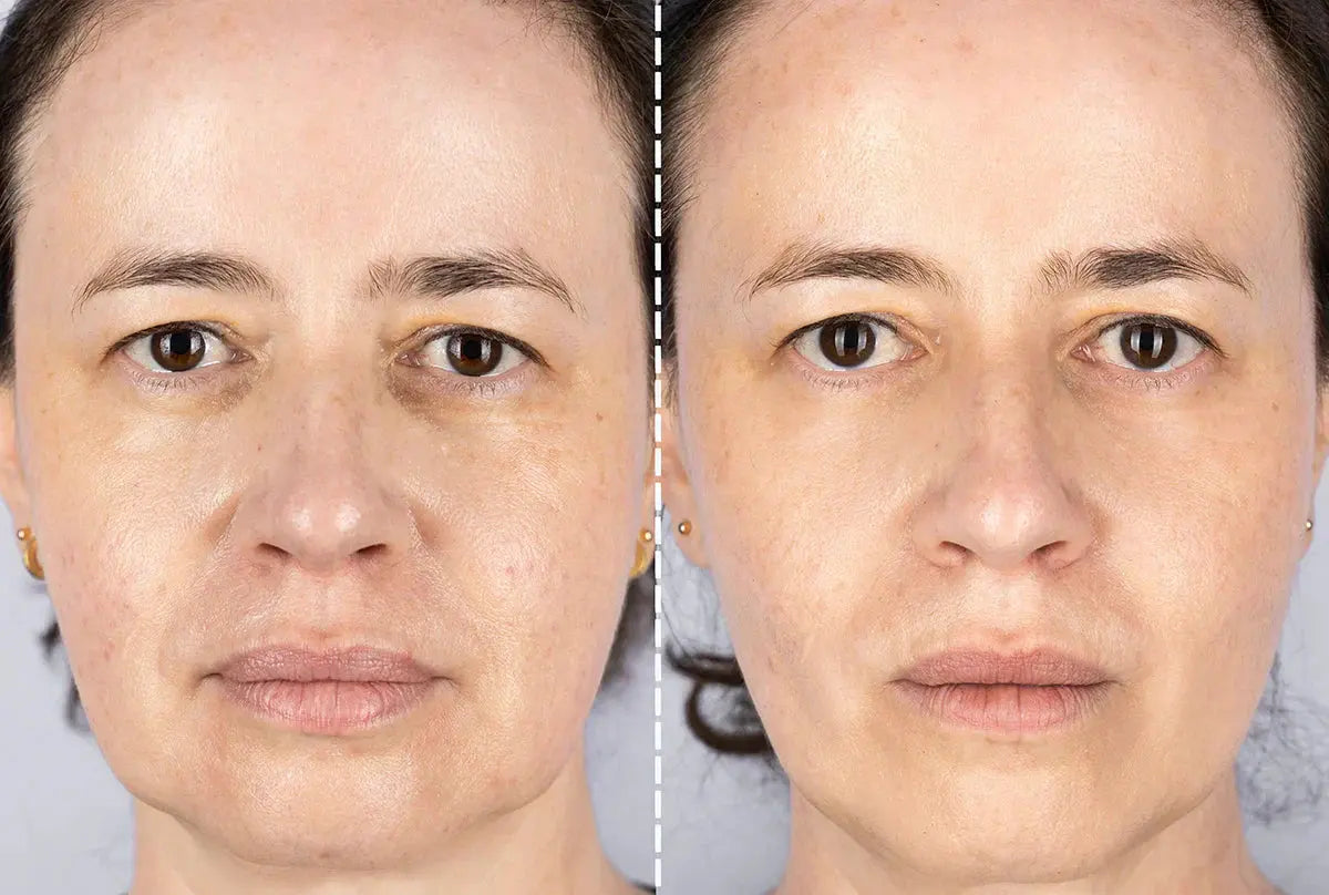 How With Red Light Therapy You can Reverse Sun Damage for Best Results? - EVENSKYN® How With Red Light Therapy You can Reverse Sun Damage for Best Results? - EVENSKYN®