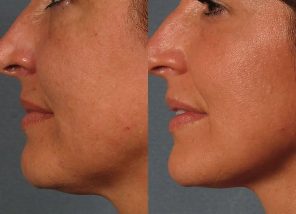 Ultrasound vs RF: Choosing the Best At-Home Skin Tightening - EVENSKYN®