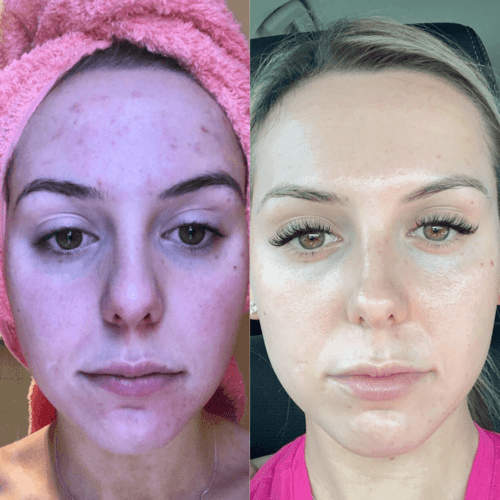 The Illuminating Journey: Unraveling the Benefits of At-Home Red Light Therapy - EVENSKYN®