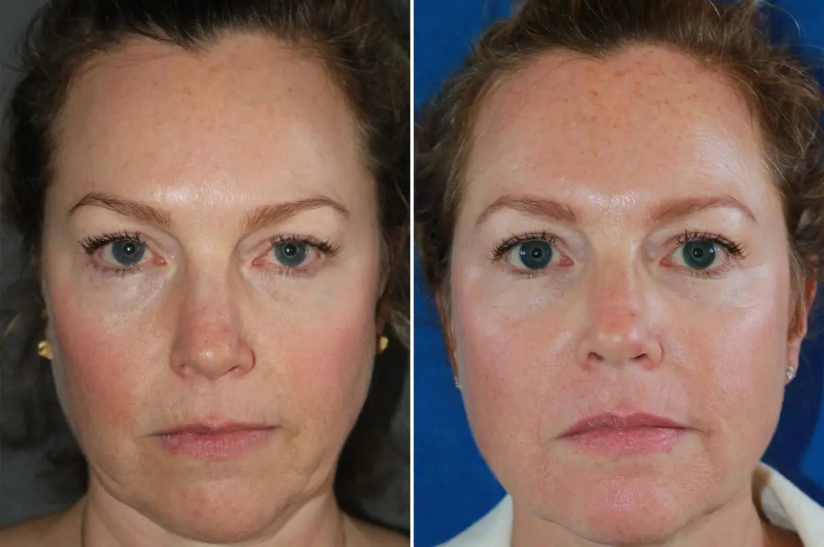 At-Home-RF-for-Skin-Firming-The-Technology-to-Sculpt-and-Rejuvenate EVENSKYN® At-Home-RF-for-Skin-Firming-The-Technology-to-Sculpt-and-Rejuvenate EVENSKYN®