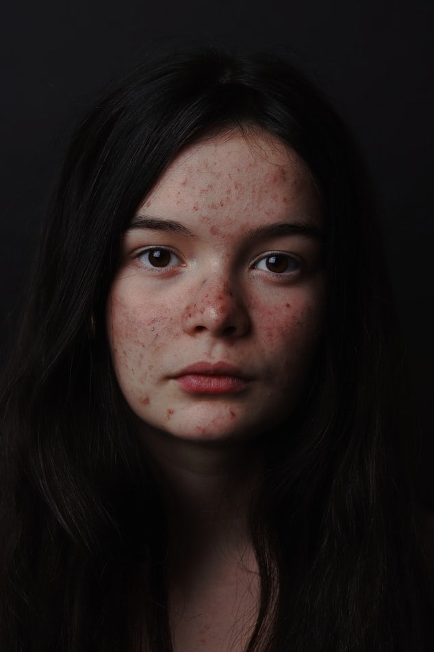 Effectiveness of Blue and Red Light Therapy to Rejuvenating the Skin and Killing Acne Causing Bacteria - EVENSKYN® Effectiveness of Blue and Red Light Therapy to Rejuvenating the Skin and Killing Acne Causing Bacteria - EVENSKYN®