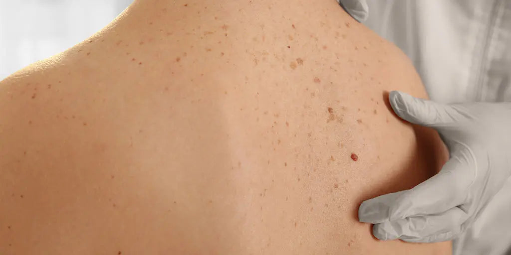 How can red light therapy help you deal with sun damage and scars - EVENSKYN® How can red light therapy help you deal with sun damage and scars - EVENSKYN®