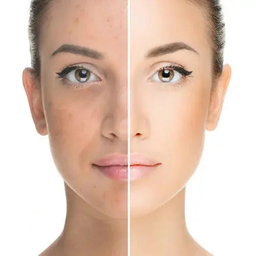 EMS vs Botox: A Natural Approach to Facial Rejuvenation at Home - EVENSKYN® EMS vs Botox: A Natural Approach to Facial Rejuvenation at Home - EVENSKYN®
