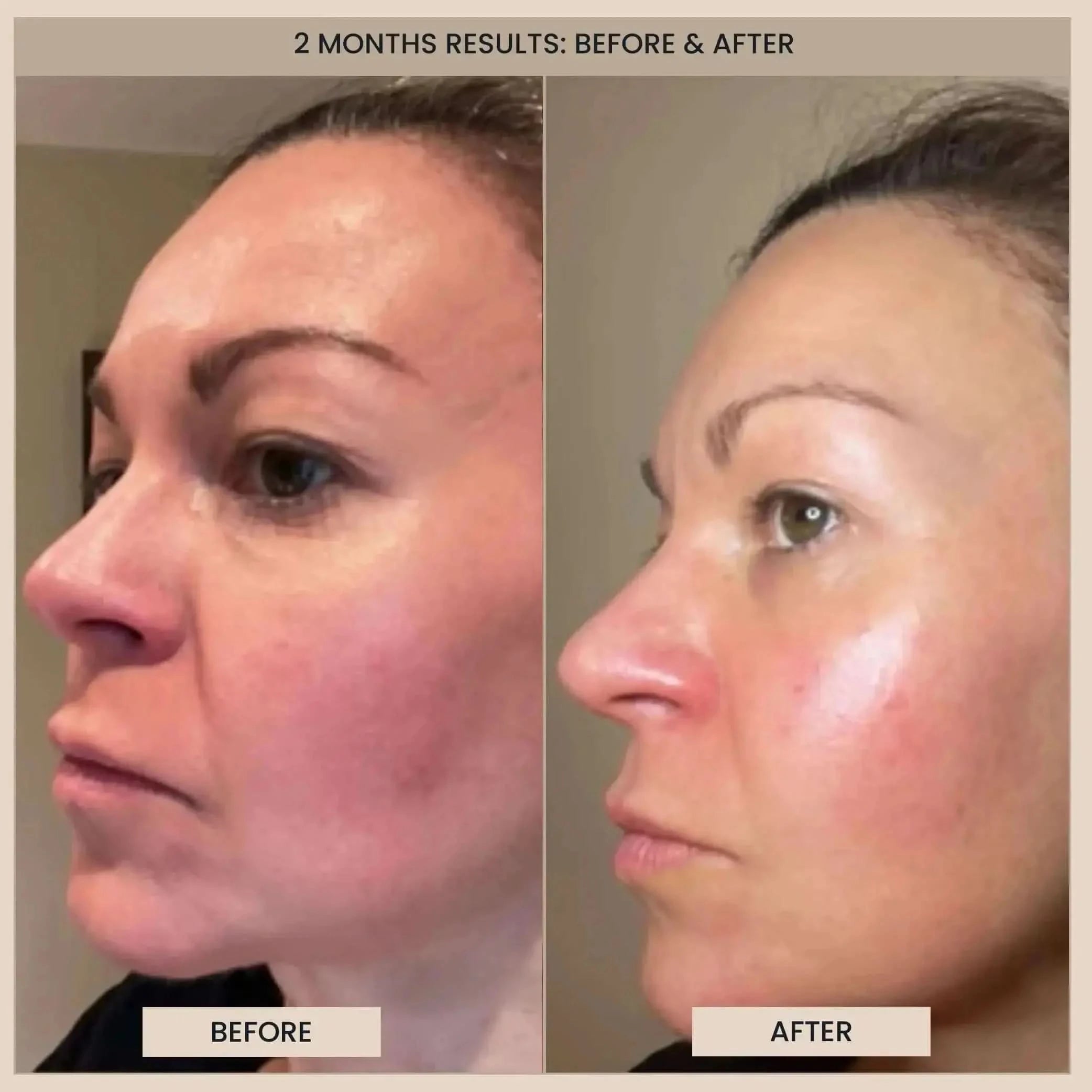 EvenSkyn® Phoenix: Premium Face Lifting Microcurrent Bar ES® Beauty Solutions EvenSkyn® Phoenix: Premium Face Lifting Microcurrent Bar ES® Beauty Solutions