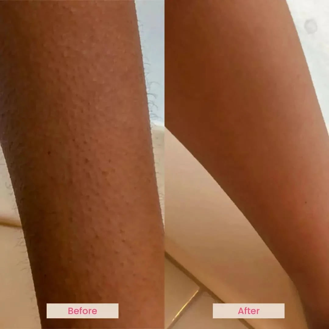 EvenSkyn® Pulsar:At-Home IPL Laser Hair Removal Handset EvenSkyn® EvenSkyn® Pulsar:At-Home IPL Laser Hair Removal Handset EvenSkyn®