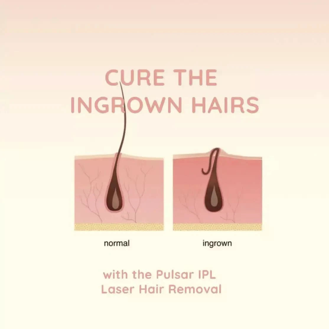 EvenSkyn® Pulsar:At-Home IPL Laser Hair Removal Handset EvenSkyn® EvenSkyn® Pulsar:At-Home IPL Laser Hair Removal Handset EvenSkyn®