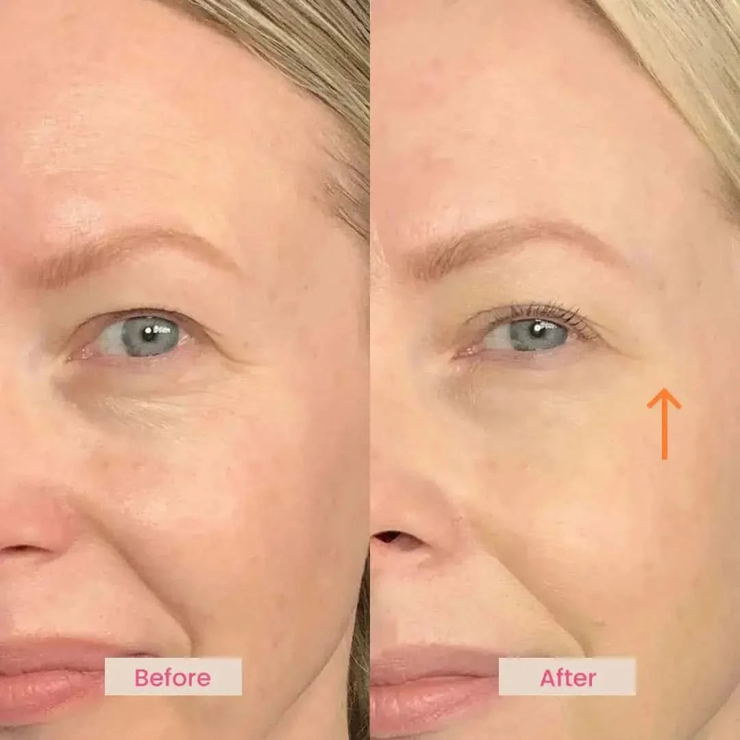 EvenSkyn® Venus: Advanced Eyelid Anti-Aging Device EvenSkyn® Beauty Solutions EvenSkyn® Venus: Advanced Eyelid Anti-Aging Device EvenSkyn® Beauty Solutions