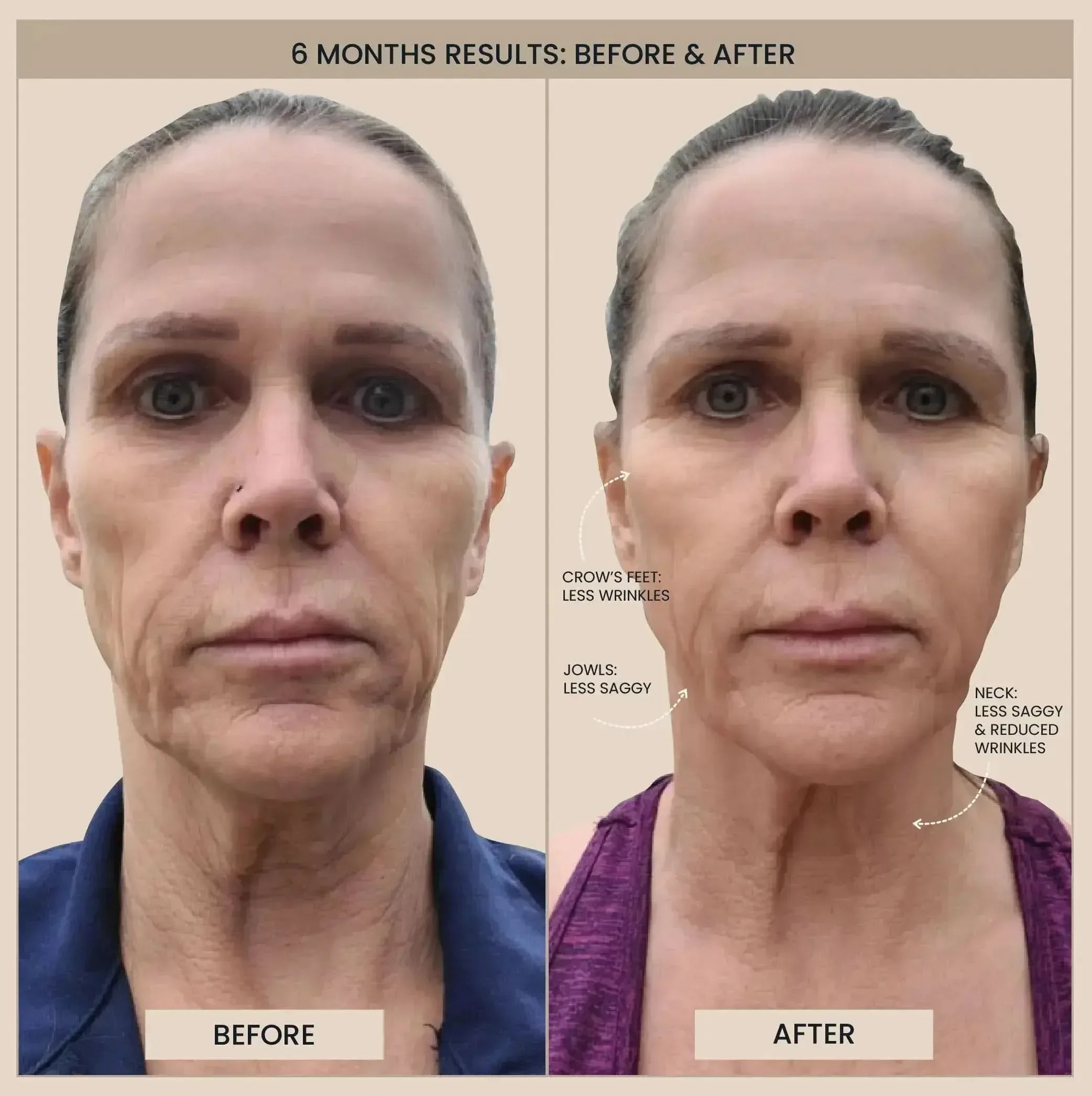 Lumo⁺ + Phoenix: Professional-Grade Skin Tightening and Lifting Duo - EVENSKYN® Lumo⁺ + Phoenix: Professional-Grade Skin Tightening and Lifting Duo - EVENSKYN®