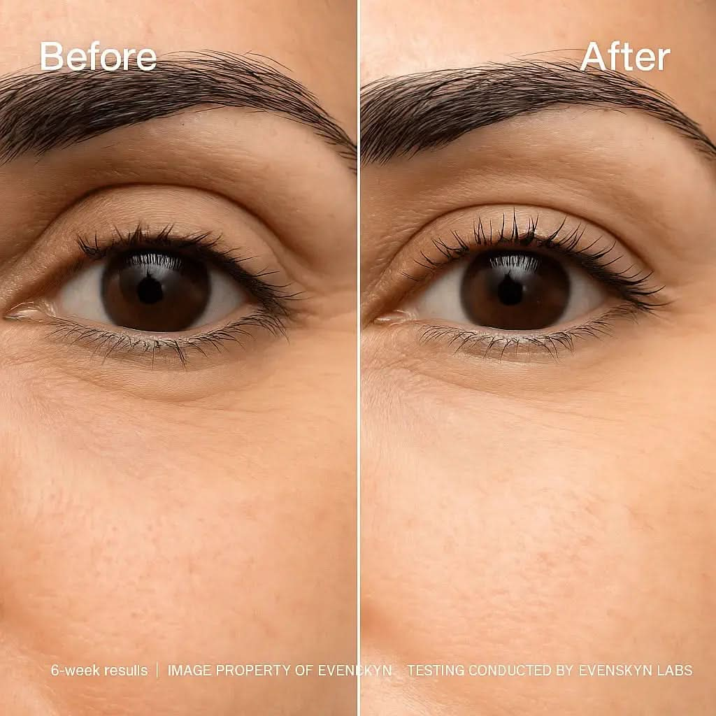 Before and after results of under-eye patches showing wrinkle reduction and skin tightening. Before and after results of under-eye patches showing wrinkle reduction and skin tightening.