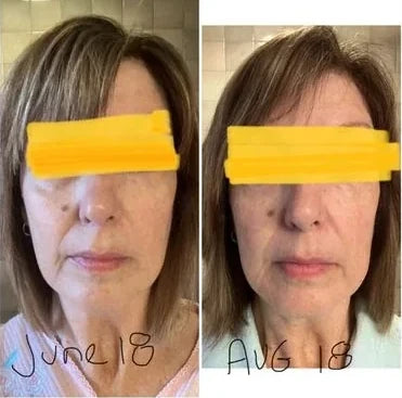 Tammy L.’s own before and after, from a review of the Lumo+