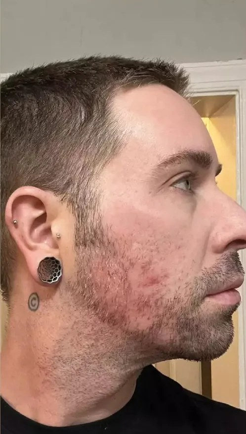 Before using the original Lumo: a man’s cheek and jawline in profile