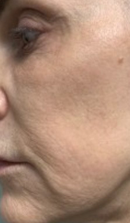 Before using the Lumo+: a customer’s lower face and neck