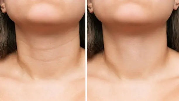  Reducing Neck Wrinkles with Red Light Therapy