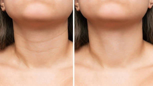  Reducing Neck Wrinkles with Red Light Therapy
