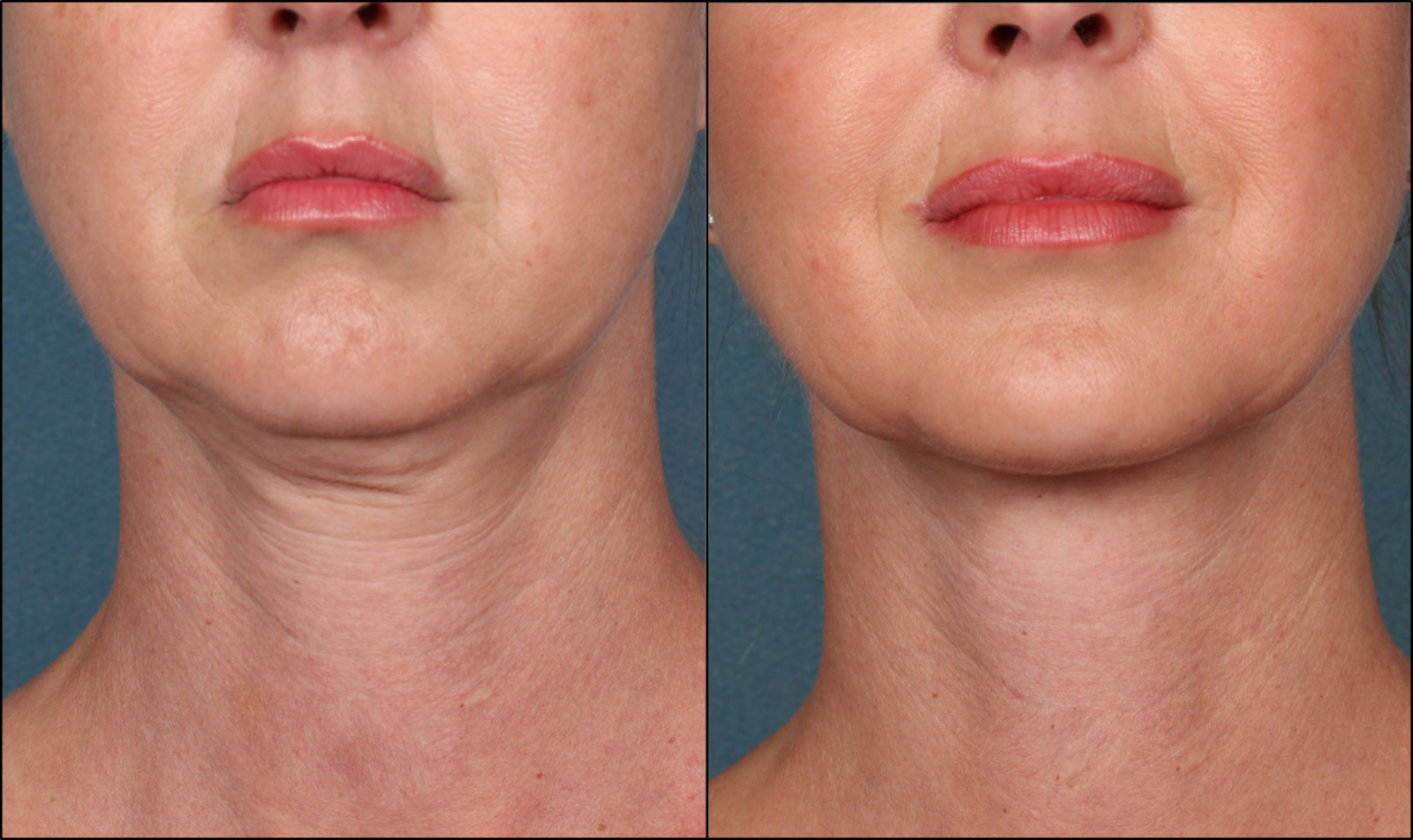 Ultrasound vs. Microneedling: At-Home Skin Tightening Options