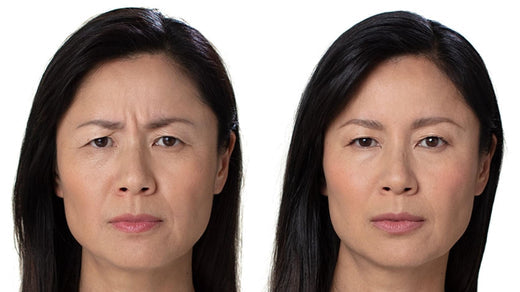 Reduce Forehead Wrinkles