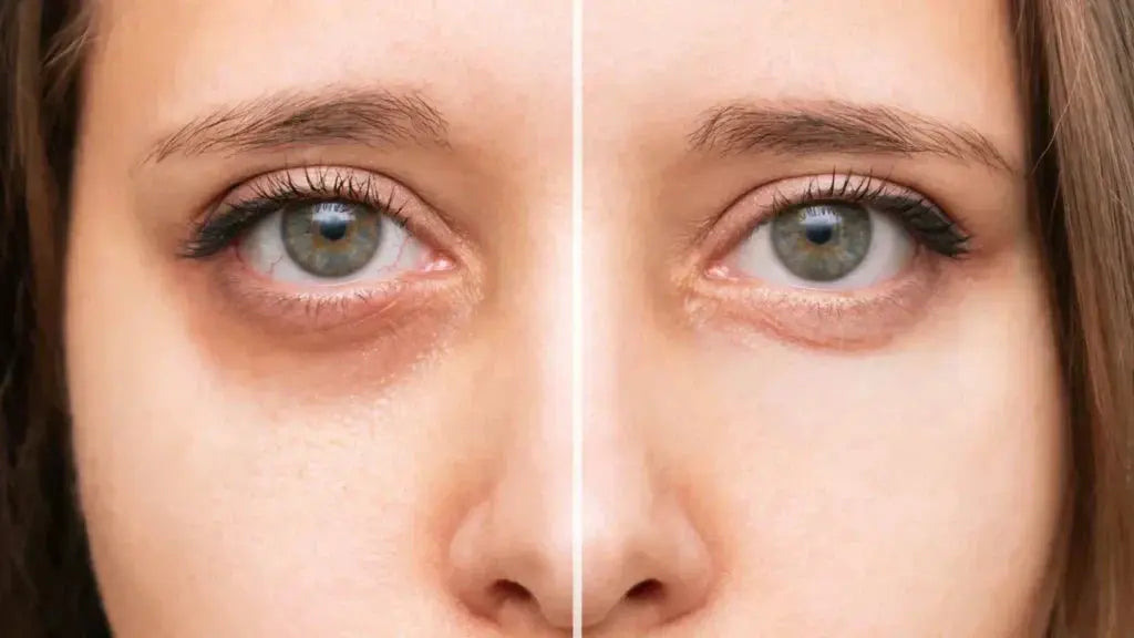 How is Red Light Therapy Used for the Reduction of Dark Circles and Puffy Eyes? - EVENSKYN® 