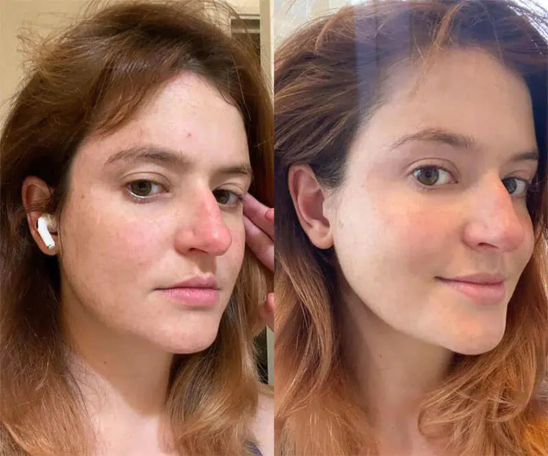 Red Light Therapy Before and After