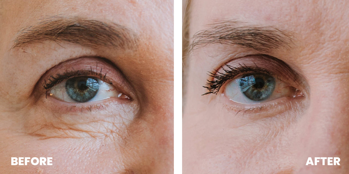 This NextLevel Skincare Device Will Get Rid of Your UnderEye Circles