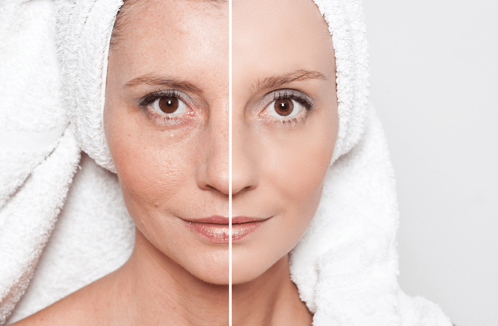 DIY Radiofrequency (RF) Skin Tightening: The Latest Techniques