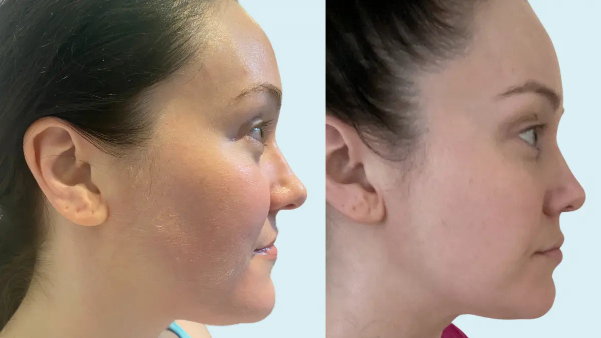 Achieving a Youthful Neck and Decolletage with At-Home Ultrasound - EVENSKYN® 