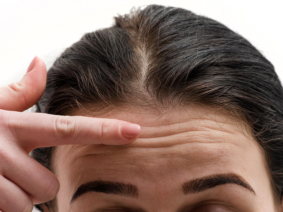 Treating forehead fine lines and wrinkles