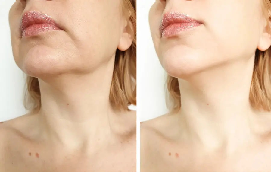 Ultrasound Technology for Skin Tightening: A Home Spa Experience - EVENSKYN® 