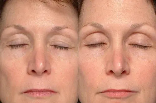 Microcurrent Marvels: Unveiling the Secrets of At-Home Skin Lifting and Toning - EVENSKYN® 