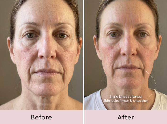 Before and after comparison, front view of a woman's smile lines and lower face