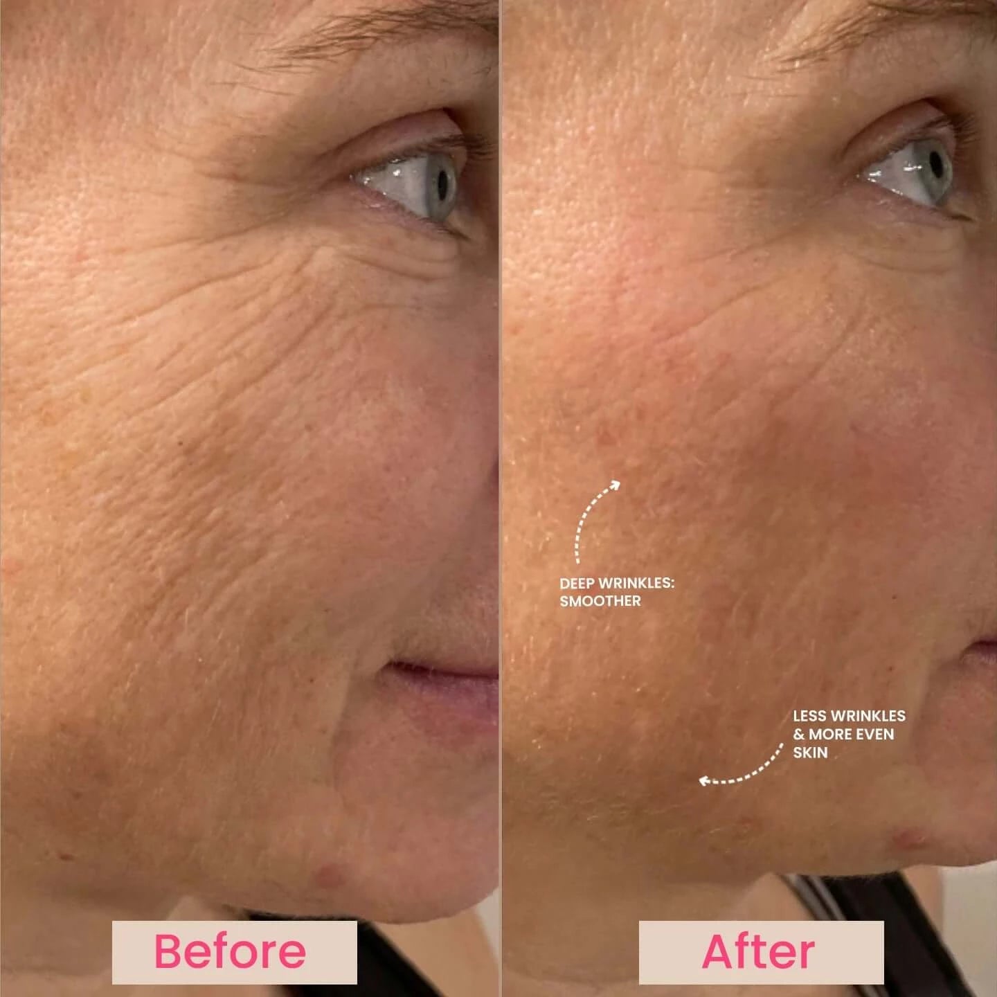 EvenSkyn® Lumo⁺: Premium Anti-Aging & Skin Tightening Handset