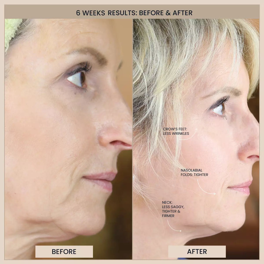 Customer before and after photos of the face in profile. The image is labelled: 6 weeks results.