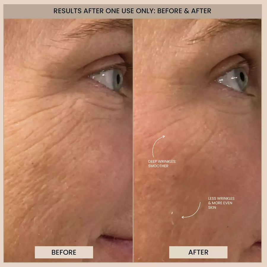 Customer before and after photos of the cheek and eye area. A label is printed on the image.