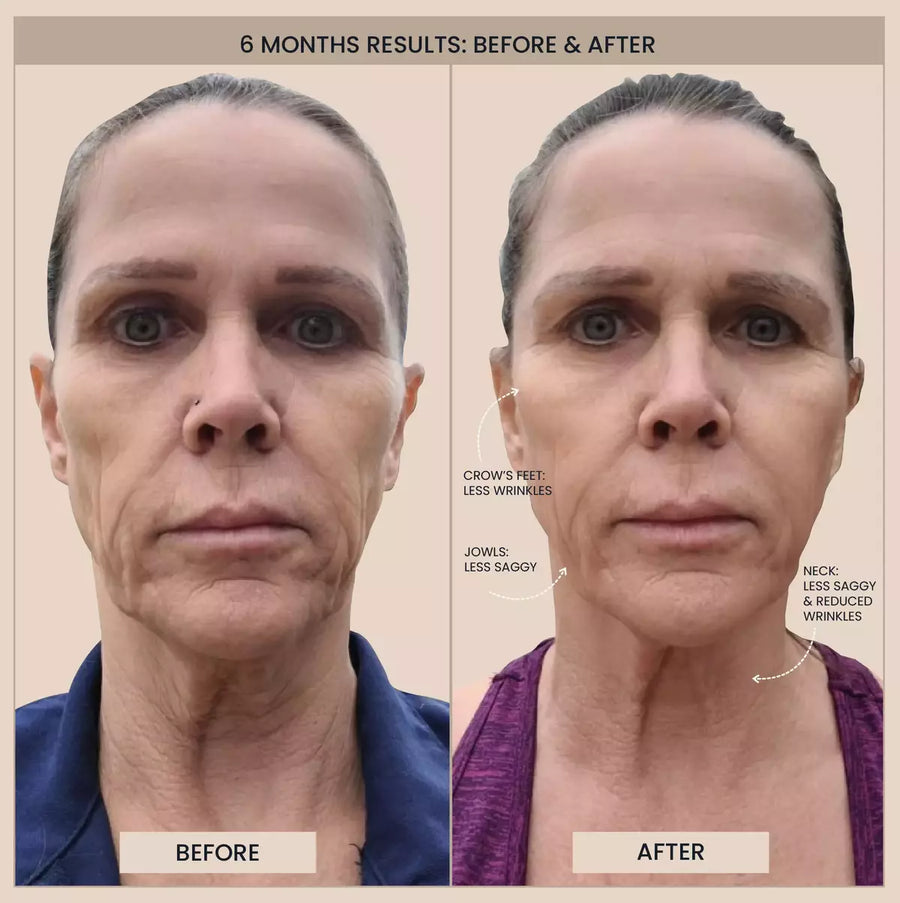 Customer before and after photos of the full face. The image is labelled: 6 months results.