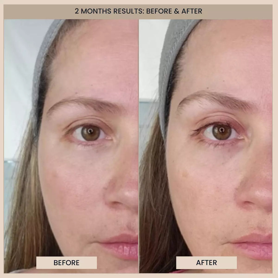 Customer before and after photos of one side of the face. The image is labelled: 2 months results.