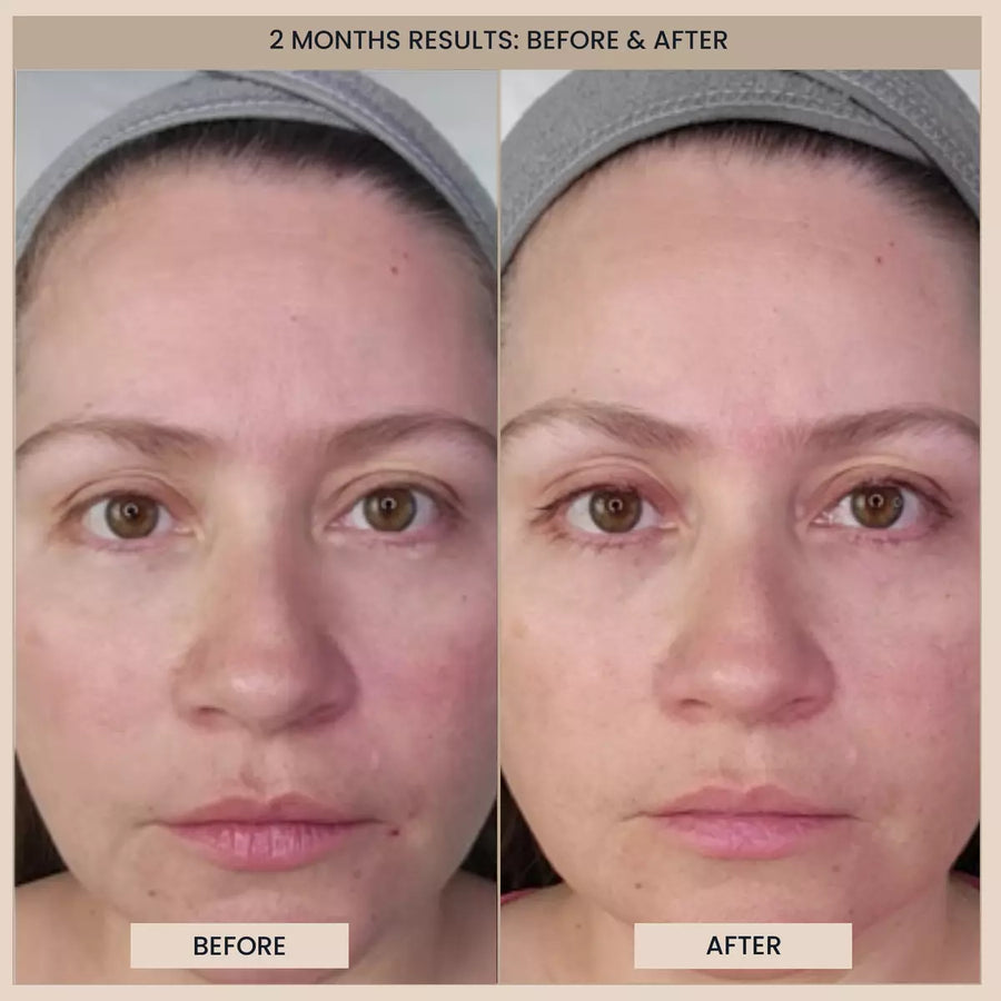 Customer before and after photos of the full face. The image is labelled: 2 months results.