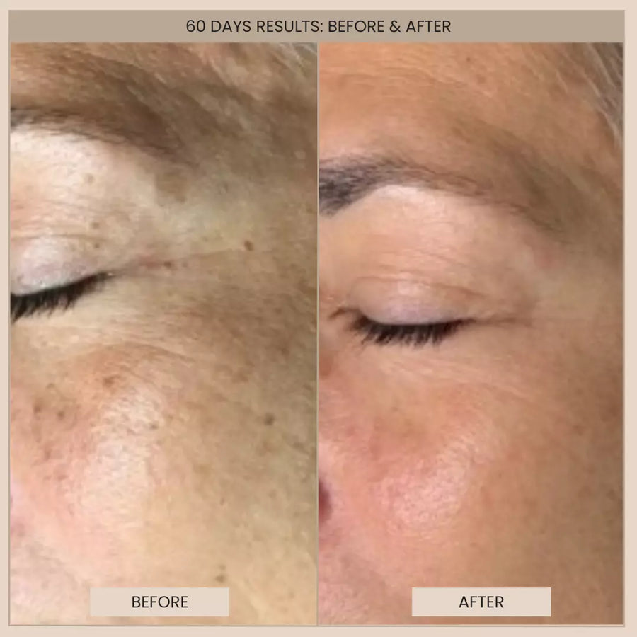 Customer before and after photos of the cheek. The image is labelled: 60 days results.