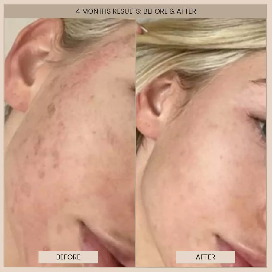 Customer before and after photos of the cheek in profile. The image is labelled: 4 months results.
