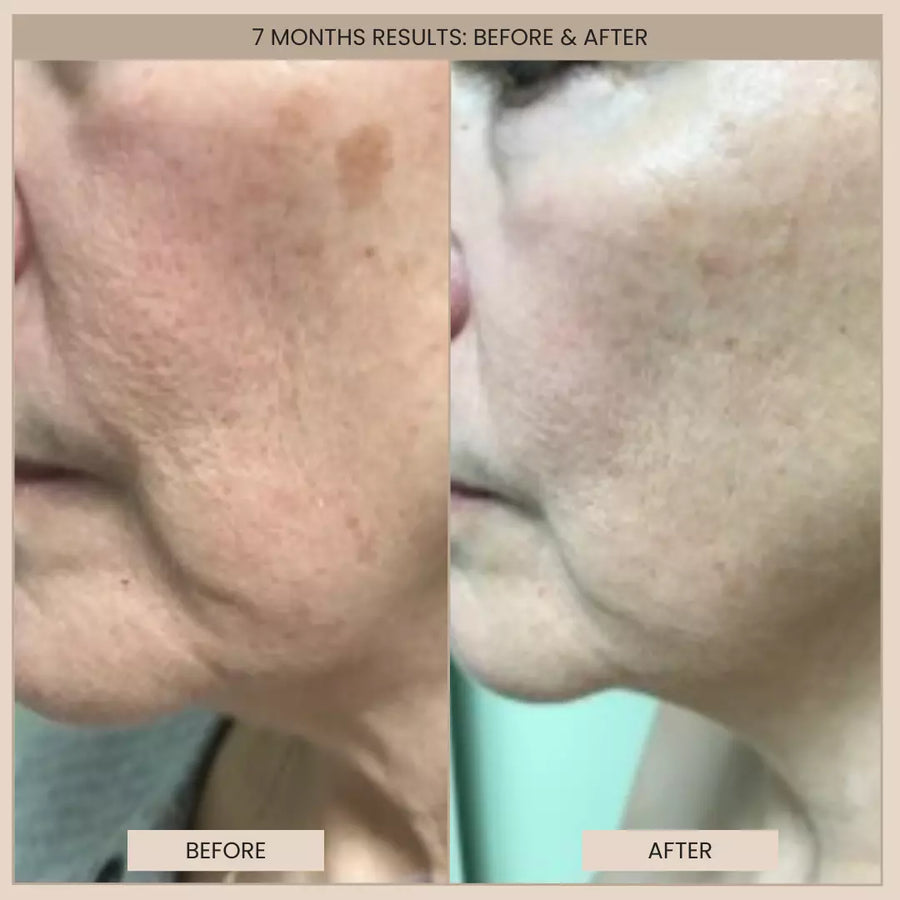 Customer before and after photos of the lower face and jaw in profile. The image is labelled: 7 months results.