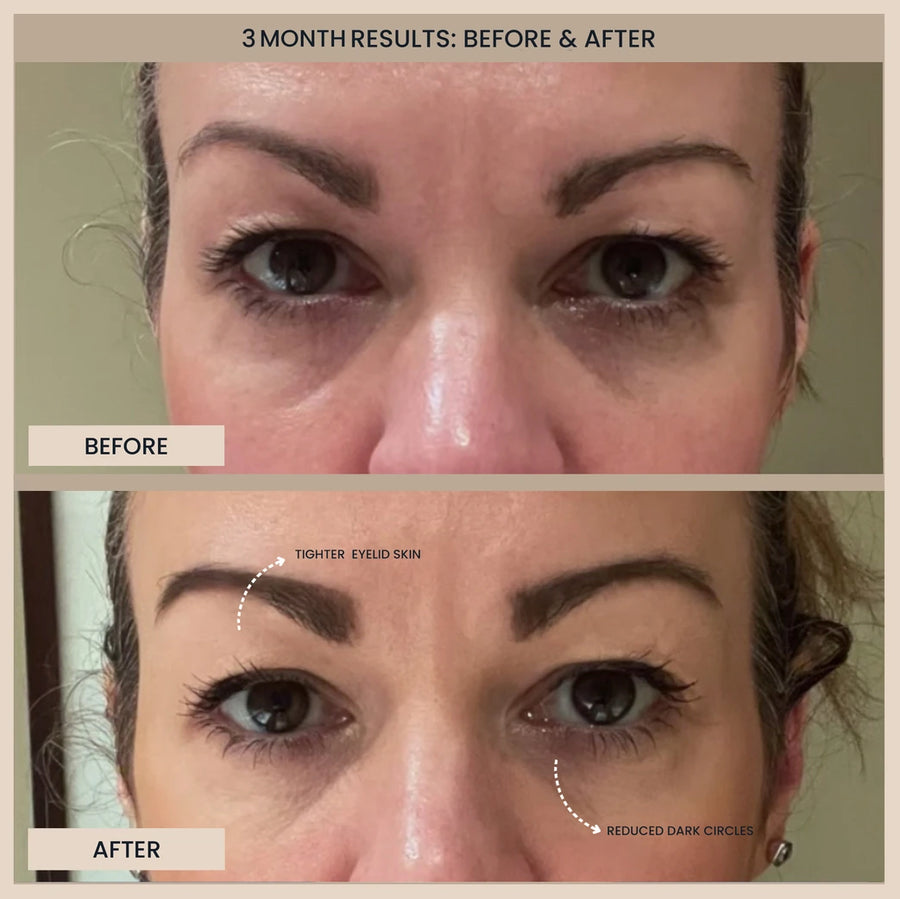 Customer before and after photos of the eyes. The image is labelled: 3 month results.