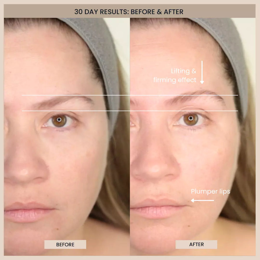Customer before and after photos of the forehead and eyes. The image is labelled: 30 day results.