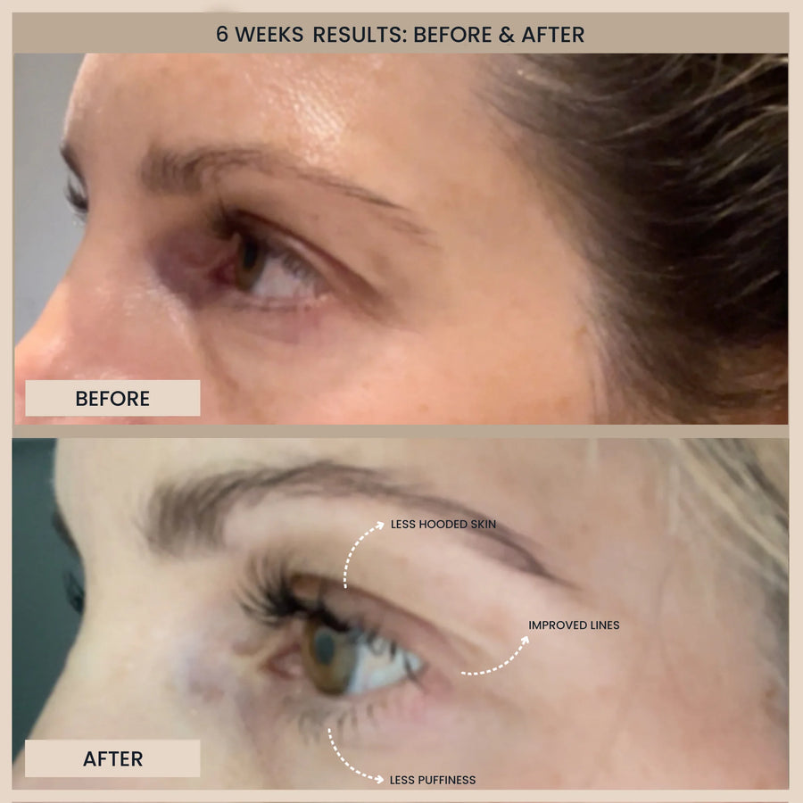 Customer before and after photos of the eye area in profile. The image is labelled: 6 weeks results.