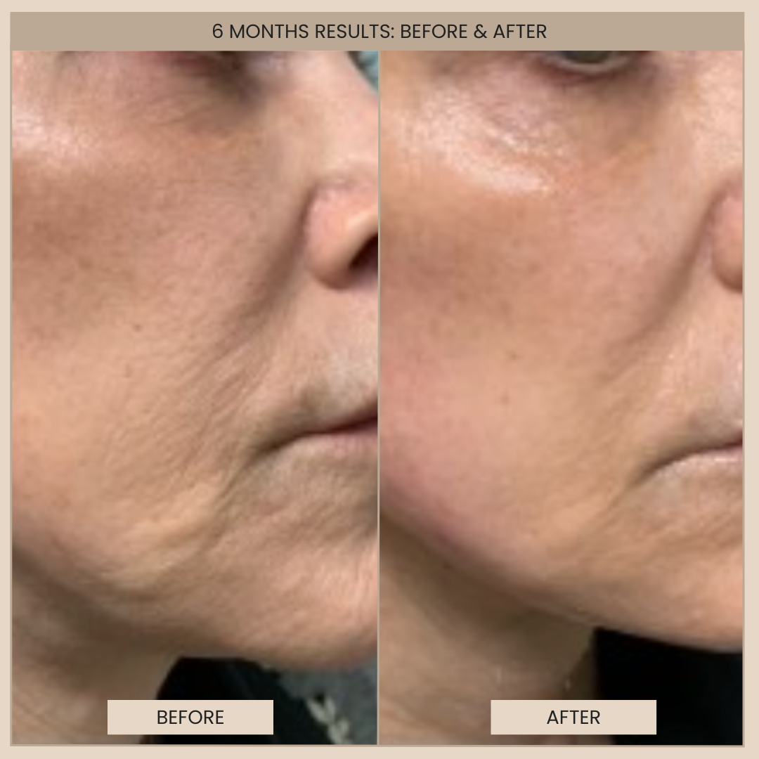 EvenSkyn® Lumo⁺: Premium Anti-Aging & Skin Tightening Handset