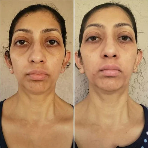 Prerana V.’s own before and after, from a review of the Lumo+