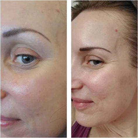 Cara P.’s own before and after, from a review of the Lumo and Venus