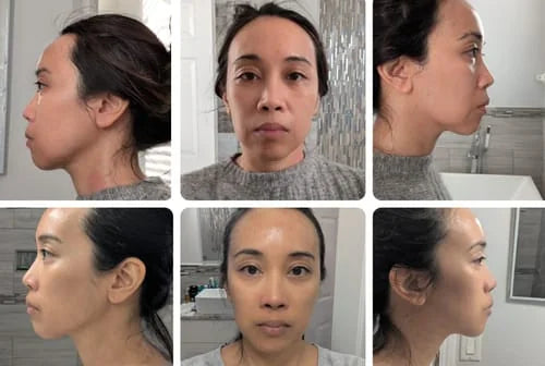 Amanda P.’s own before and after, from a review of the Lumo+