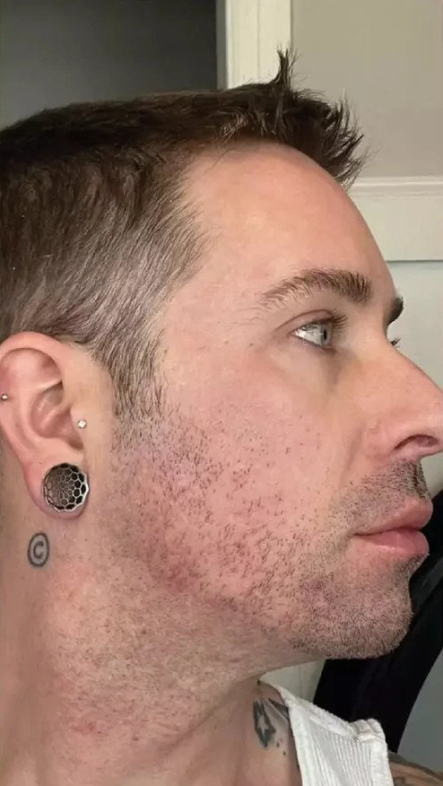 After 6 weeks with the original Lumo: a man’s cheek and jawline in profile
