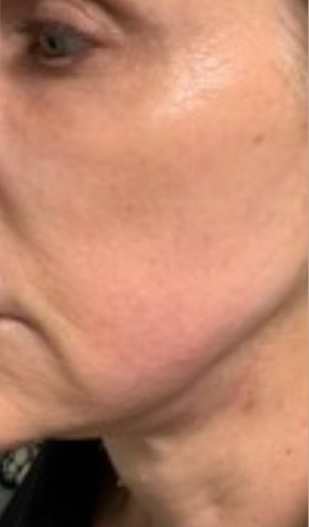 After 5 months with the Lumo+: a customer's lower face and neck