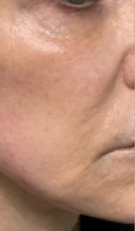 After 6 months with the Lumo+: a customer's cheek