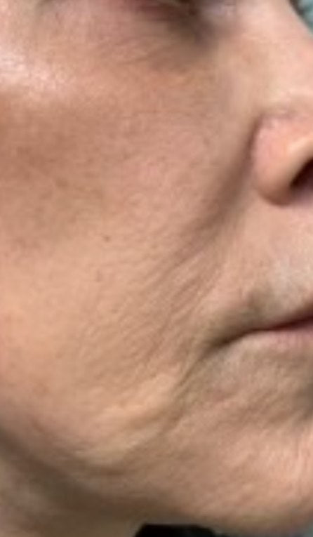 Before using the Lumo+: a customer’s cheek