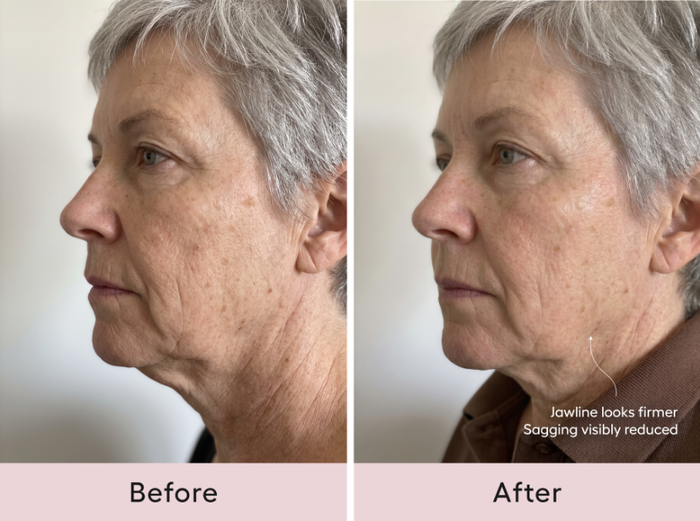 Before and after comparison, side profile of a woman's jawline and neck